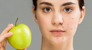Nutrition and Diet Impact on Skin