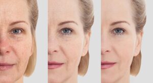 Long-Term Skin Improvement Results