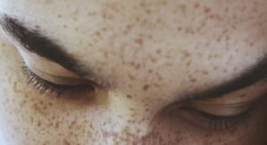 Understanding What Causes Dark Spots On Skin