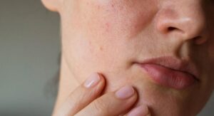 Understanding Why Oily Skin Produces Excess Sebum