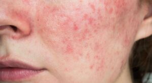 Understanding Inflammation in Skin and Its Causes