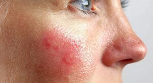 Sensitive Skin Reactions to Dr Lancer Skin Care