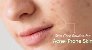Glycolic Acid Skin Care in Acne-Prone Routines