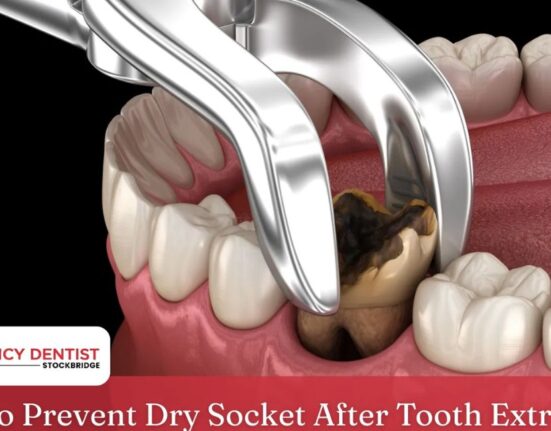 Dentist For Dry Socket - 7 How To Stop Severe Pain!