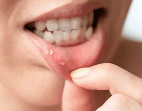 Sudden Blood Blister in the Mouth with No Pain: Causes and Treatment