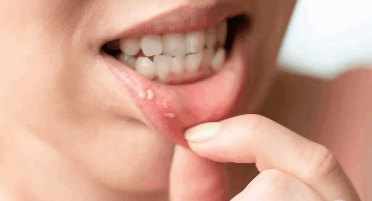 Sudden Blood Blister in the Mouth with No Pain: Causes and Treatment