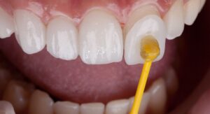 The Veneer Process- What to Expect