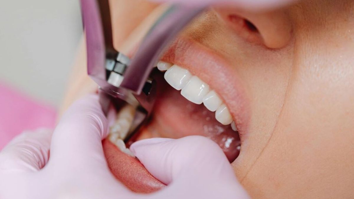 Wisdom Tooth Extraction Dentists: 8 Questions to Ask