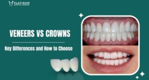 What Are Veneers, Exactly?