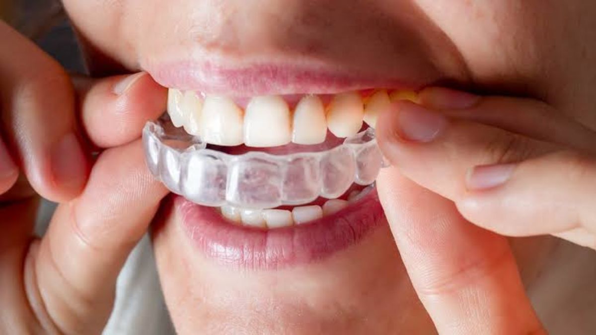 Invisalign Dentist: 7 Things to Look for Before You Choose